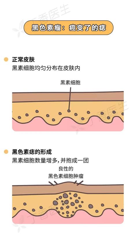 腋下有凸痣|痣也可能会癌变！长在 3 个地方要注意